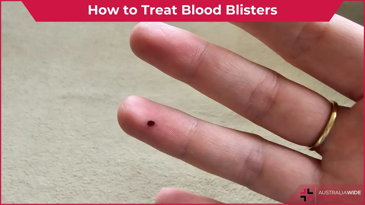 Blood blister article header